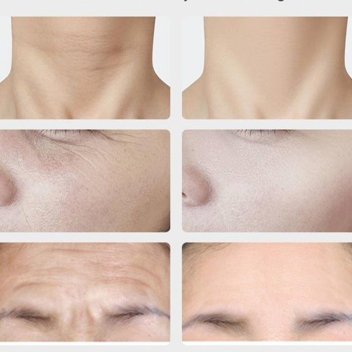 Aparelho Antirrugas Lifting Facial